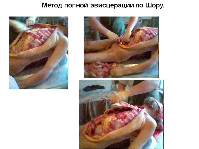 Метод полной эвисцерации по Шору.